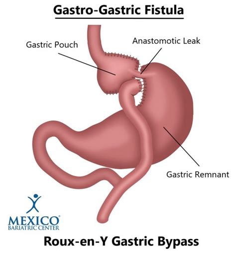 Anastomotic Leak After Gastric Bypass Surgery